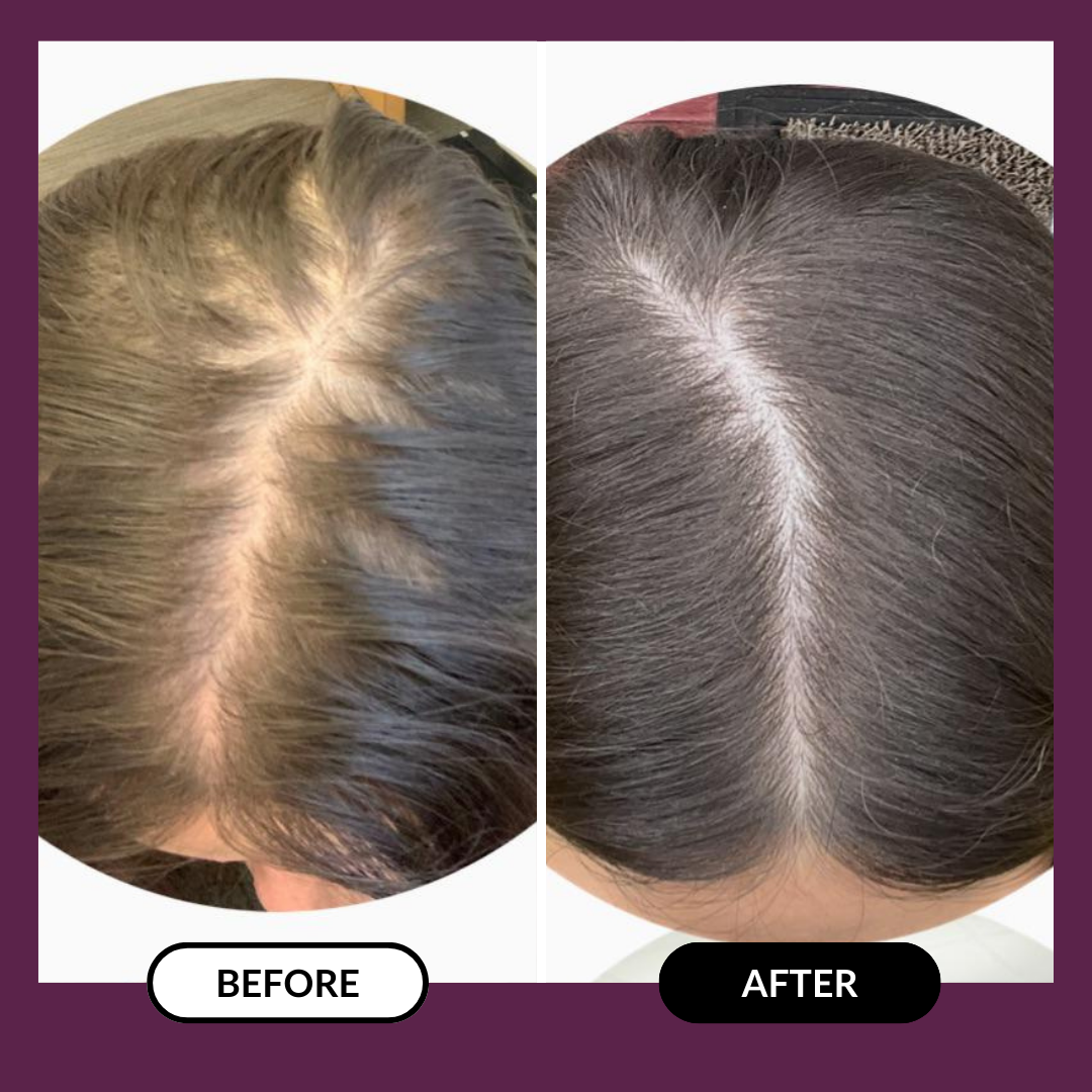 Before and after comparison of hair density improvement.