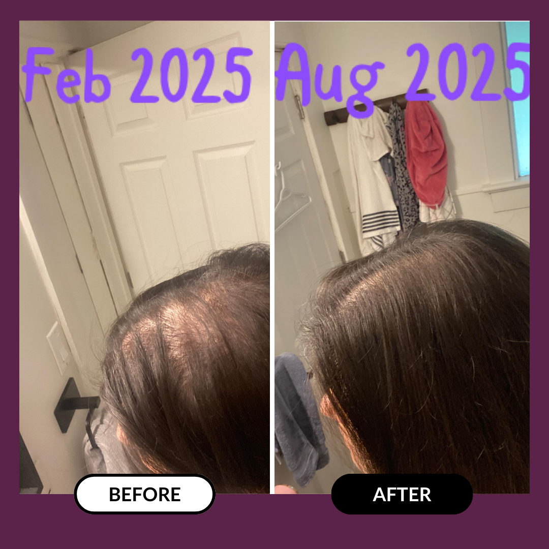 Side-by-side comparison of hair growth from February to August 2025.