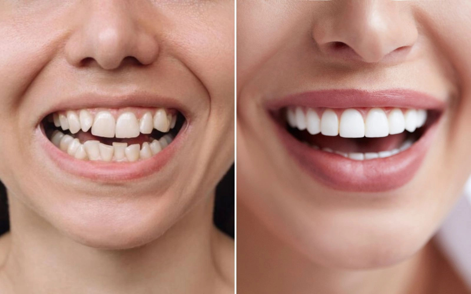 Side-by-side images of teeth before and after dental work.