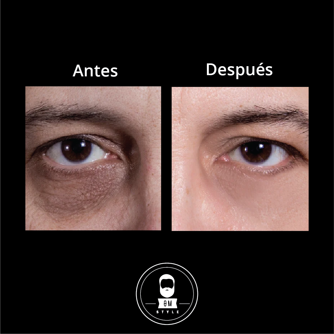 Comparison of eyes before and after treatment, showing reduced under-eye circles.