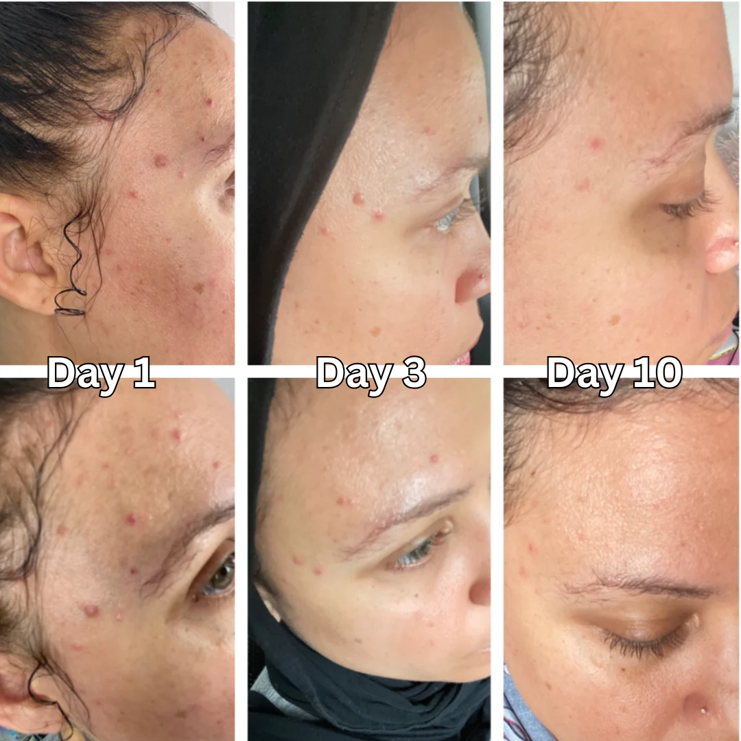 Three side-by-side images showing skin improvement over ten days.