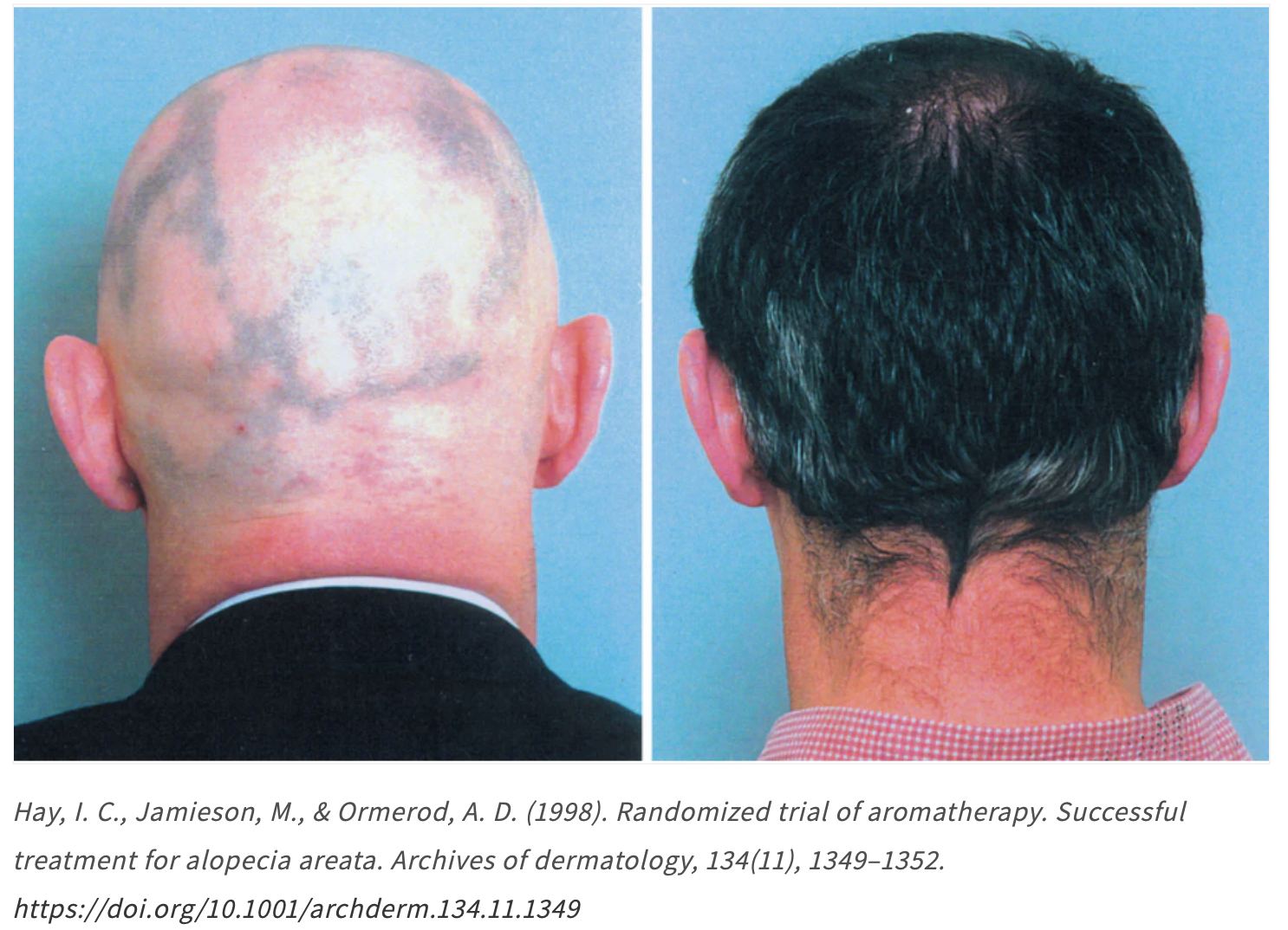 Two side-by-side images showing a bald and a hairy scalp from the back.