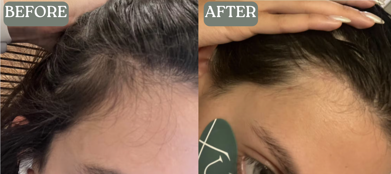 Side-by-side comparison of hairline before and after treatment.