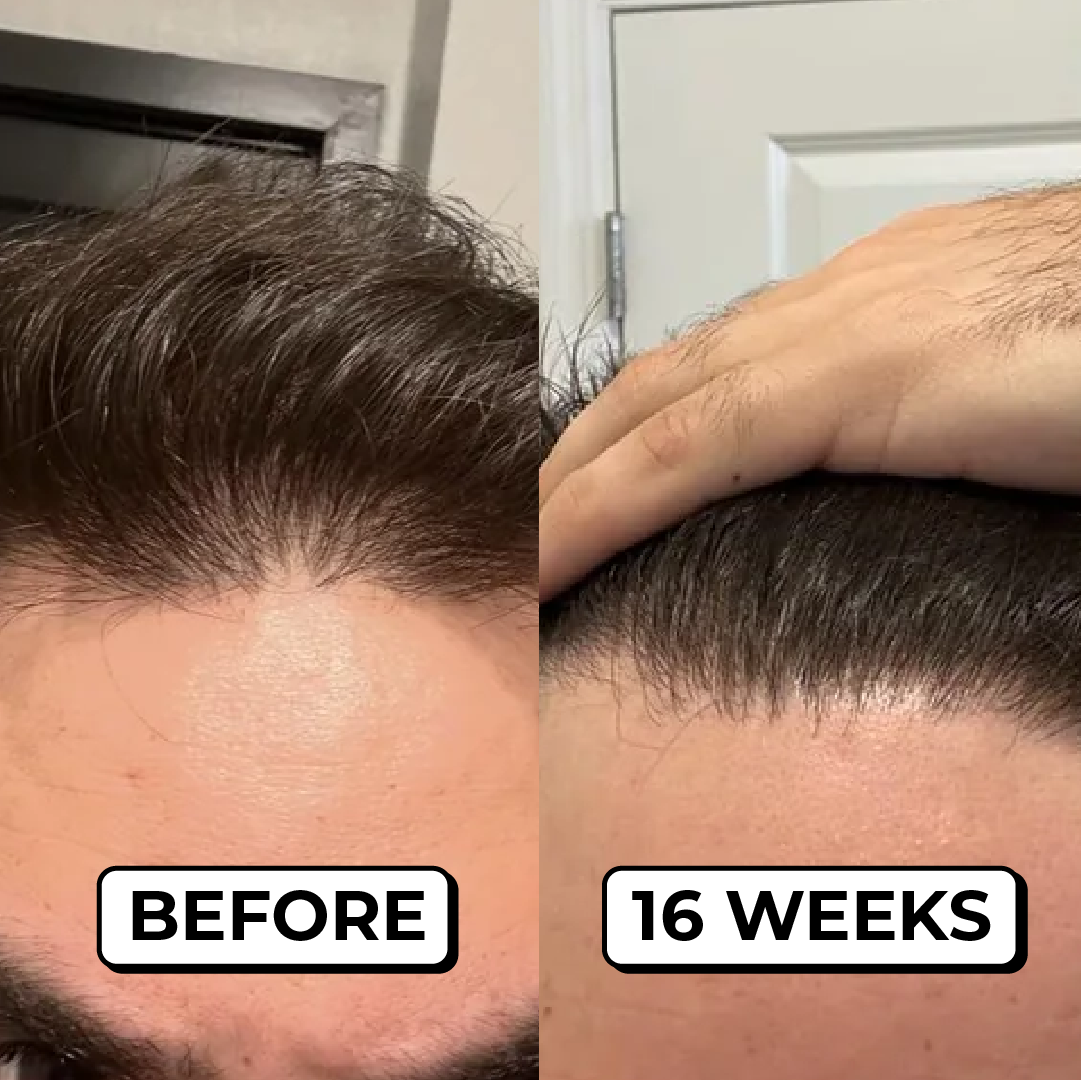 A before-and-after image showing hair regrowth along a man's hairline over a 16-week period.