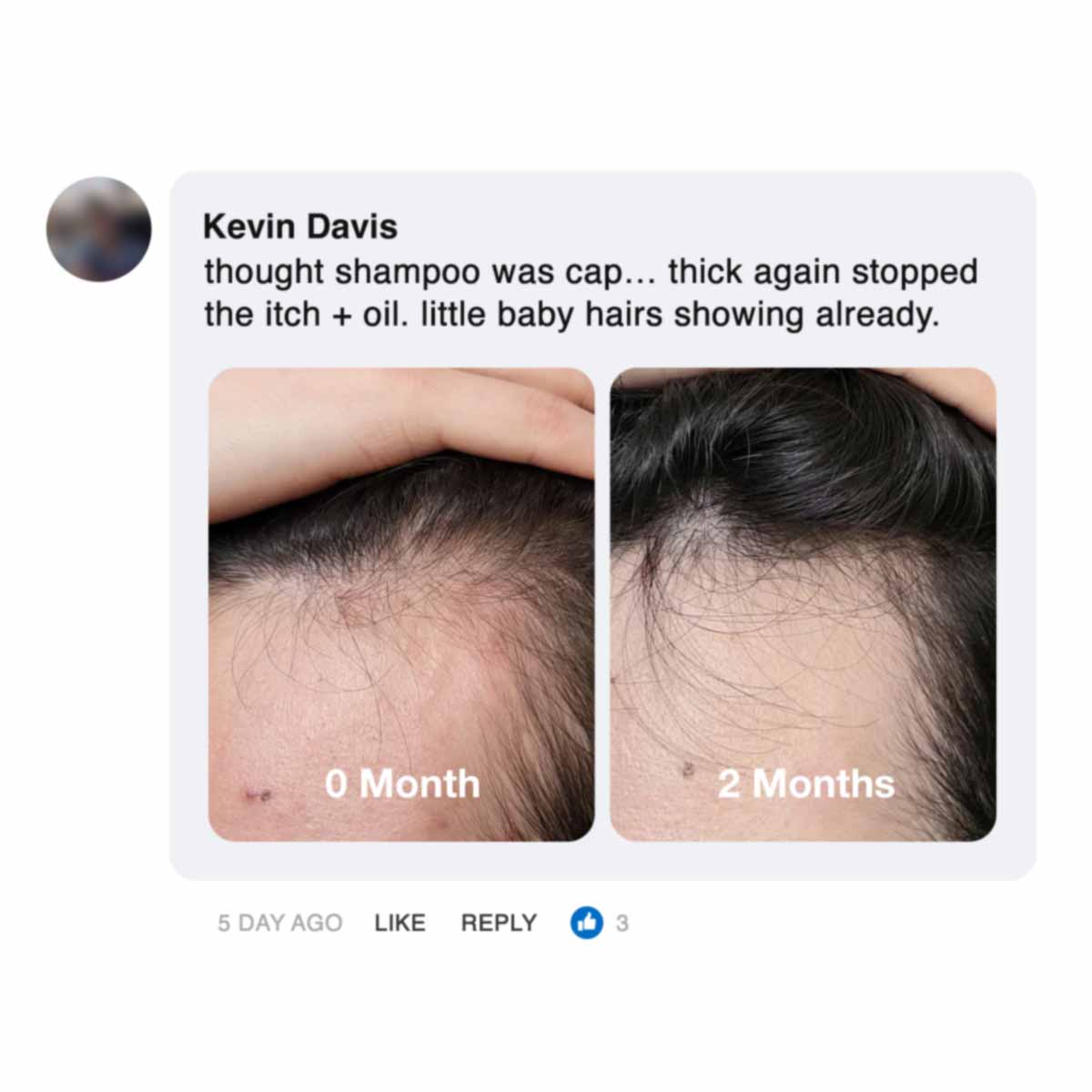 Comparison of a hairline over two months with visible hair regrowth.