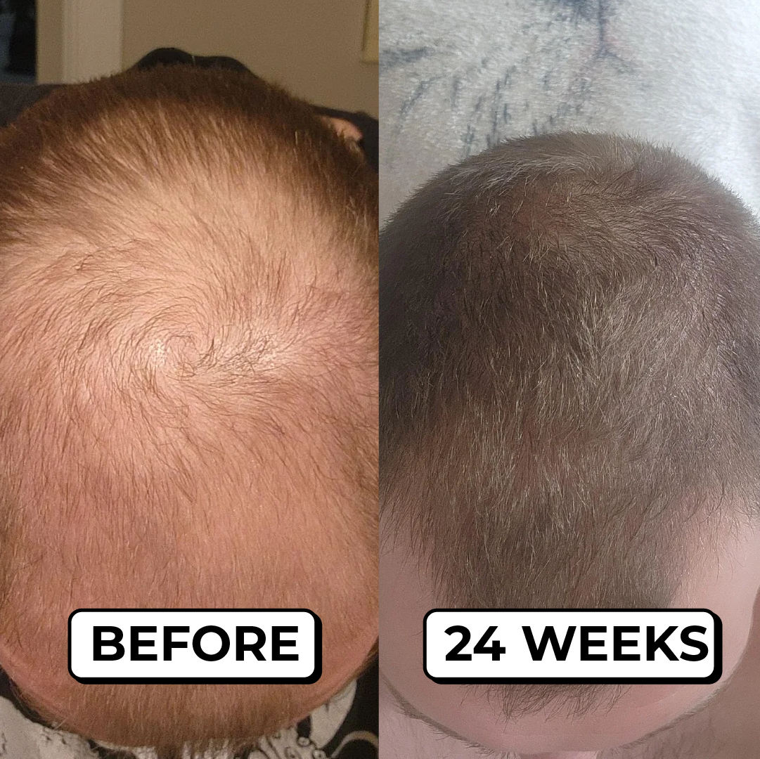 A before-and-after comparison showing hair regrowth on the crown of a man's head over 24 weeks.