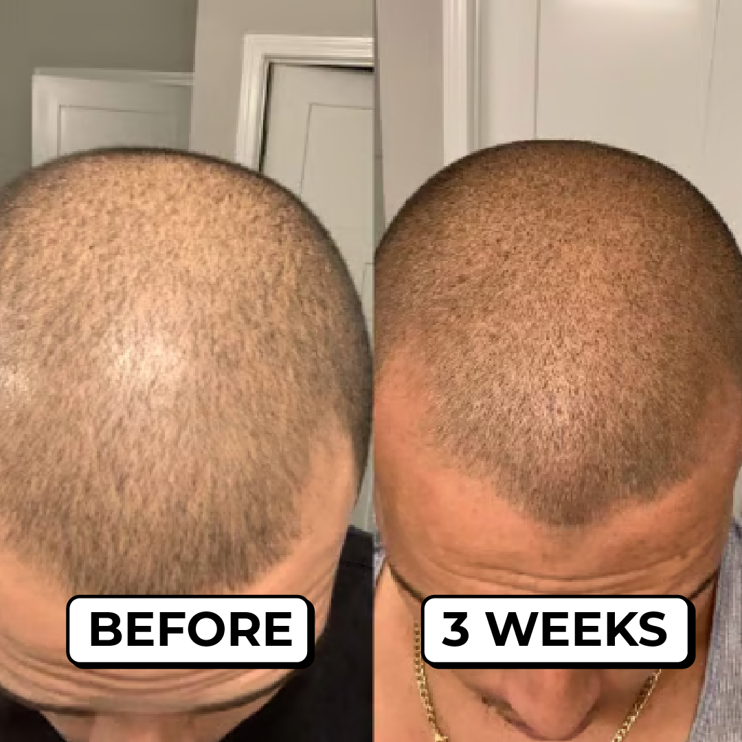 A before-and-after comparison of a man's scalp, showing a fuller, more defined hairline after three weeks.