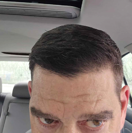 Close-up of a man's head showing a haircut inside a car.