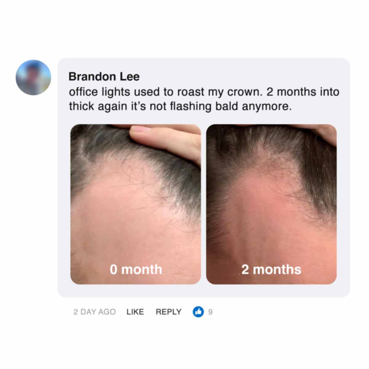 Comparison of hair growth on a human scalp over two months.