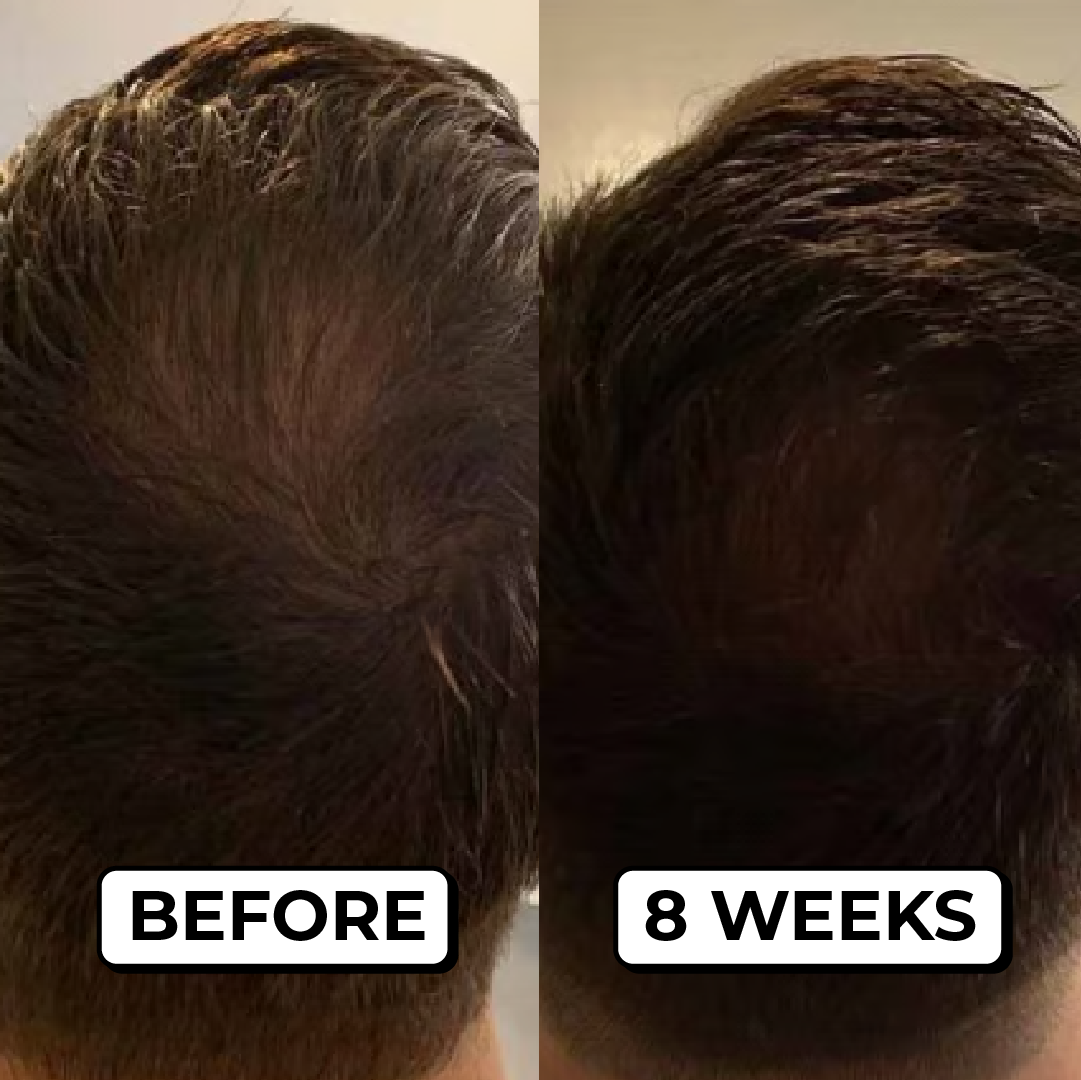 Before and after photos showing the back of a man's head, with thicker hair in the after photo.