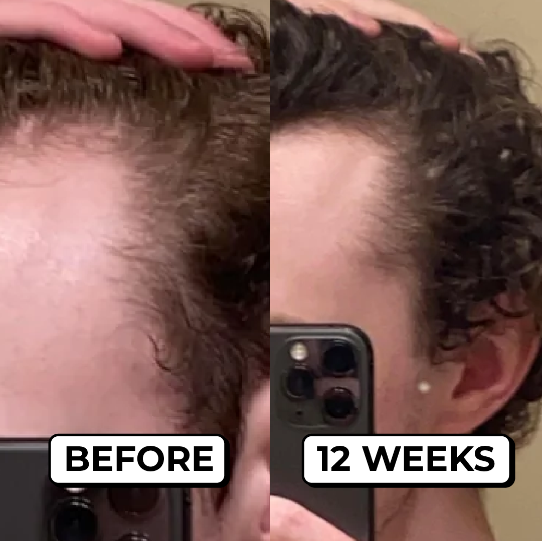 A before and after split-screen image showing hair regrowth on a man's hairline after 12 weeks.
