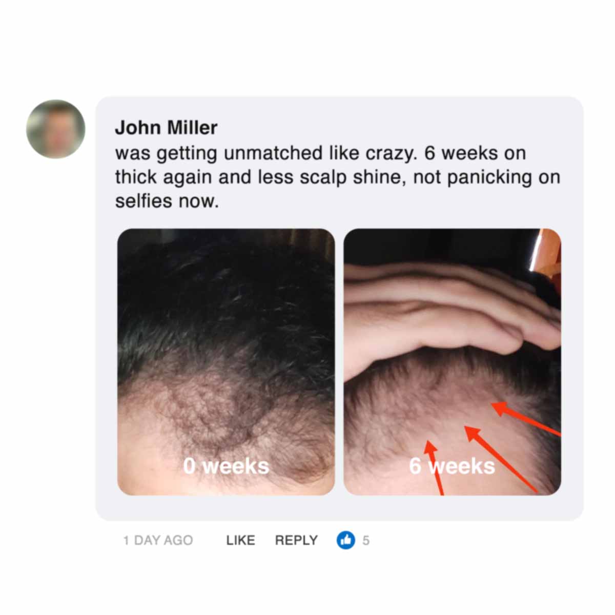 Comparison of hair growth: 0 weeks vs. 6 weeks with hand on scalp.