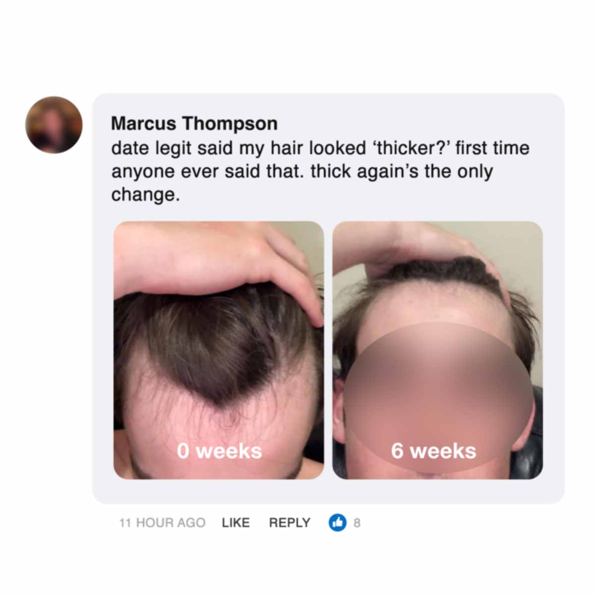 Comparison of hairline at 0 weeks and 6 weeks.