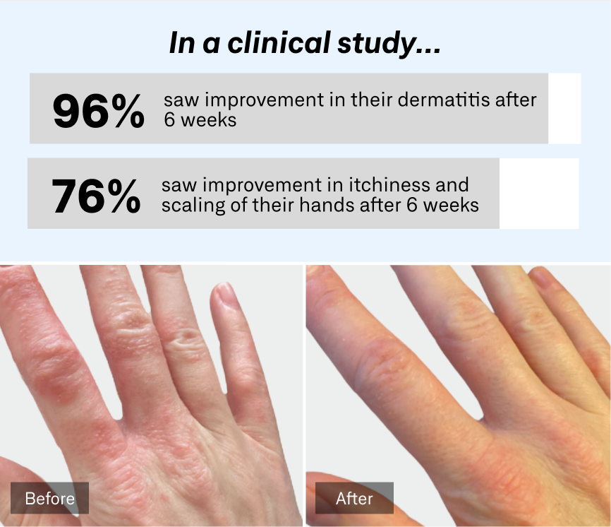 Clinical study results with before and after images of hand dermatitis improvement.