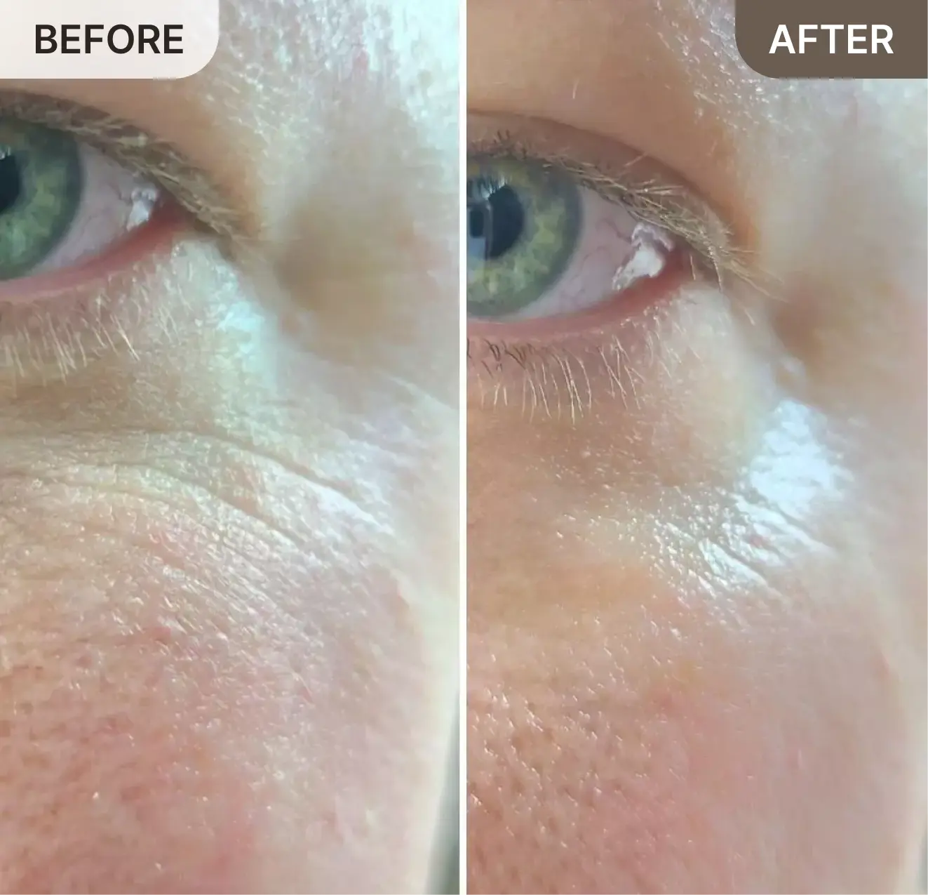 A before and after side-by-side comparison showing a reduction of wrinkles under a person's eye.