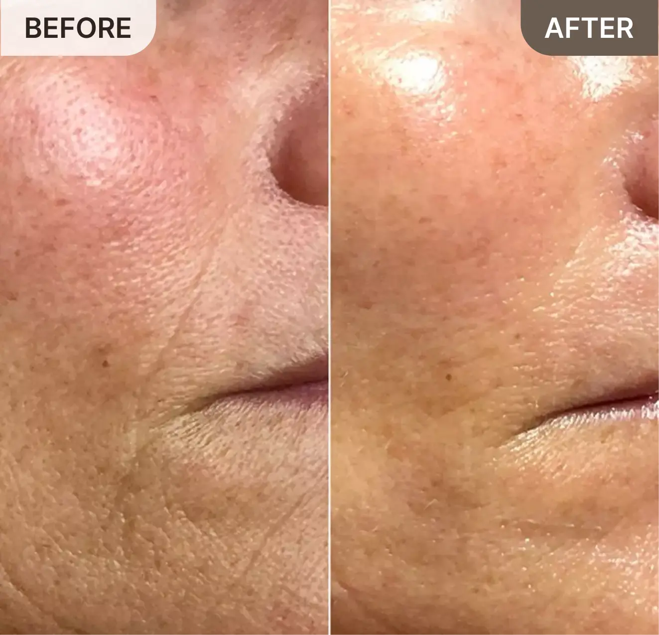 A before and after close-up of a person's cheek, showing a reduction in wrinkles and improved skin texture.