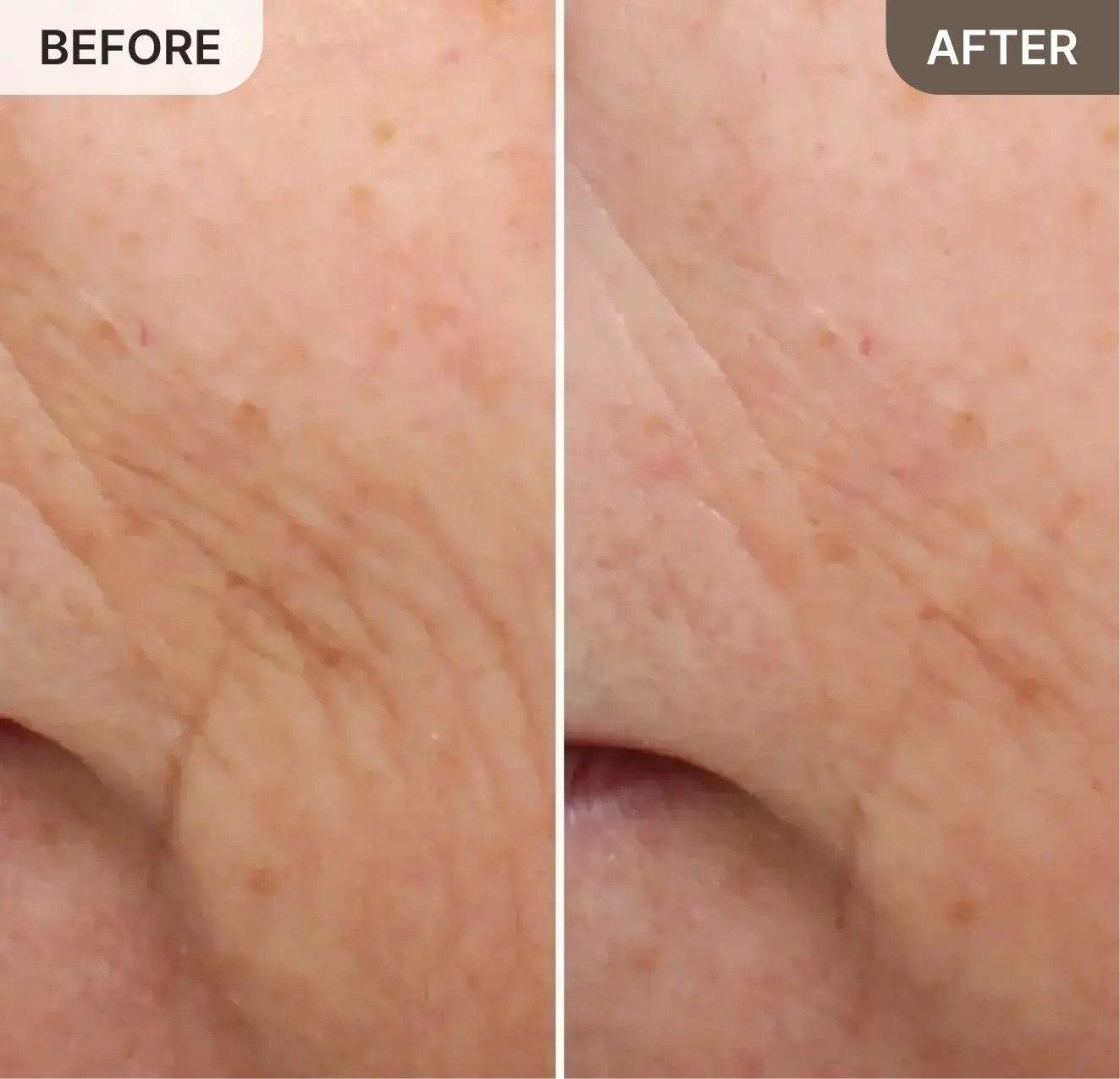 A before-and-after comparison showing a close-up of skin with a visible reduction in wrinkles.