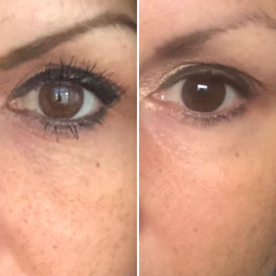 A before-and-after comparison showing a close-up of a woman's eye area, with smoother skin on the right.