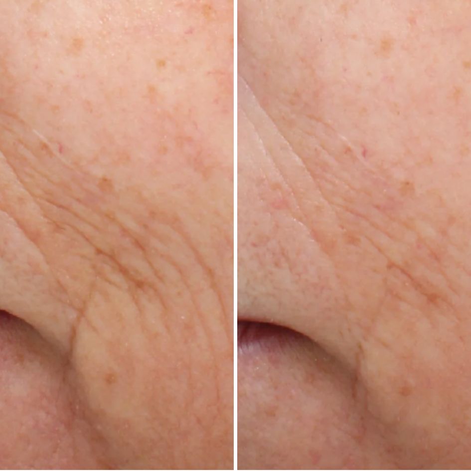 A before-and-after close-up of facial skin, showing a reduction in the appearance of fine lines and wrinkles.