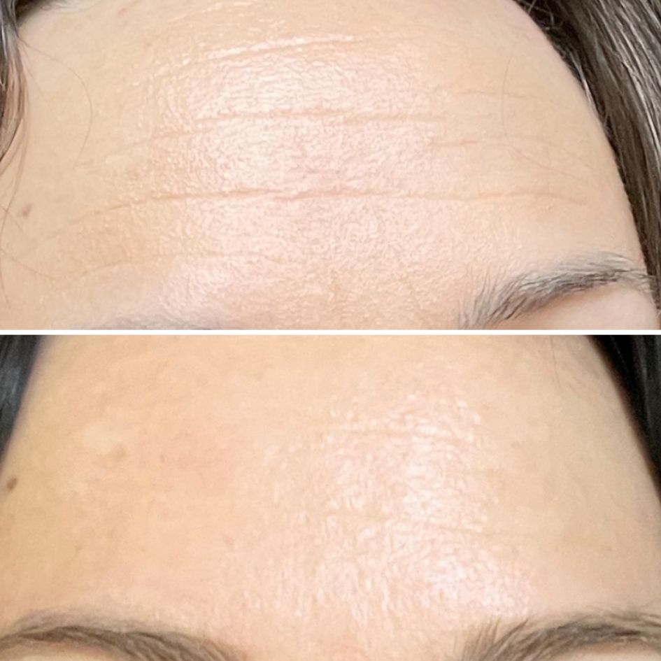 A before and after image showing a reduction of wrinkles on a person's forehead.
