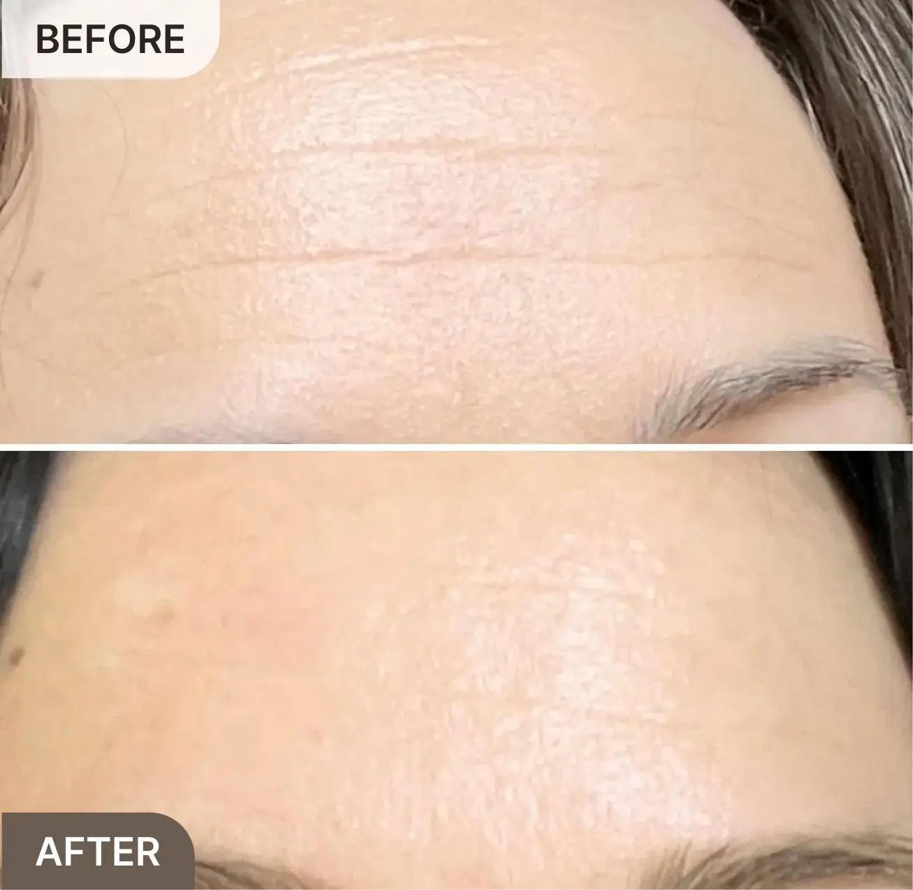 A before and after comparison of a person's forehead, showing a visible reduction in wrinkles.