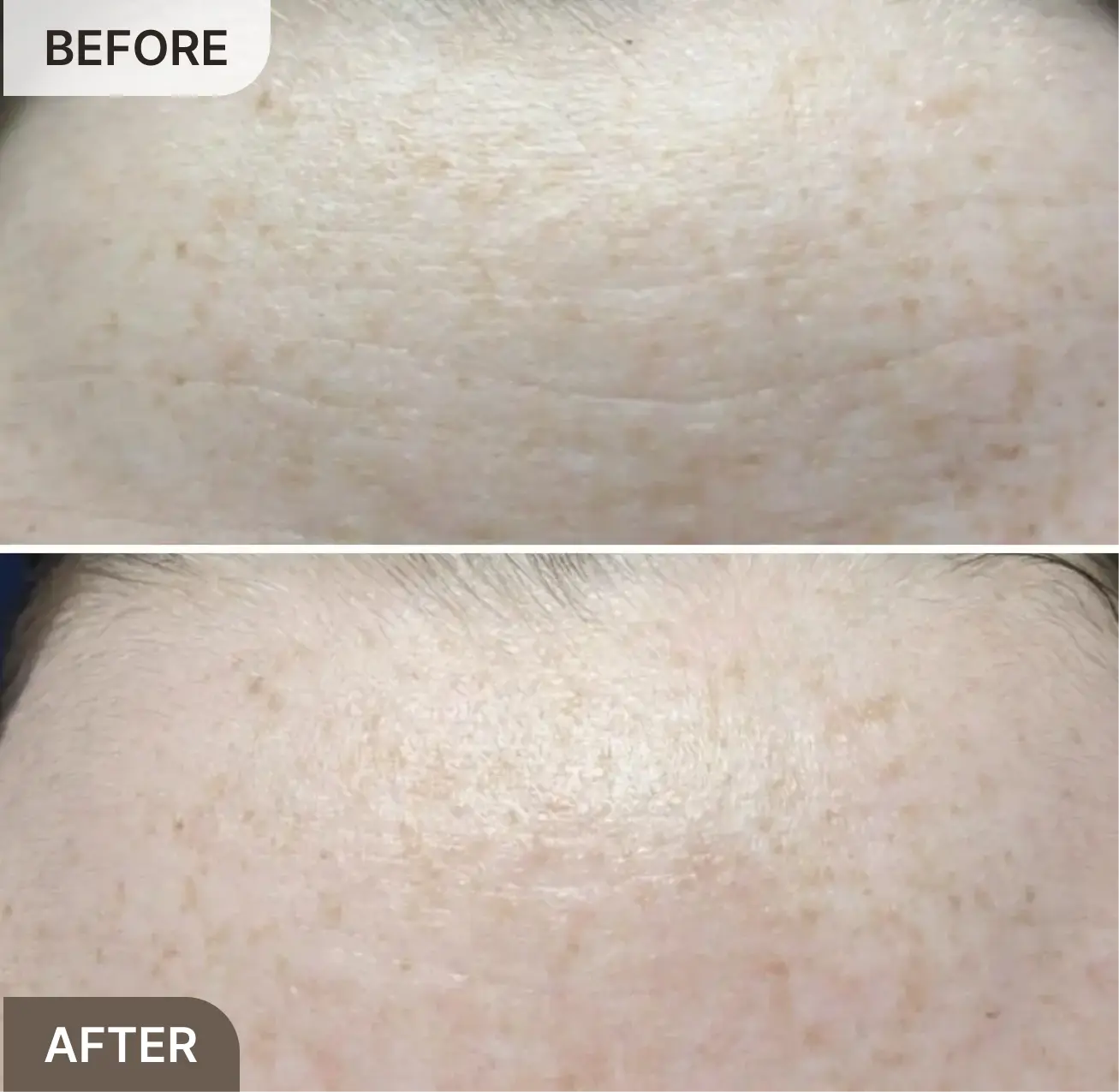 A before and after image showing a close-up of a forehead with a reduction in fine lines.
