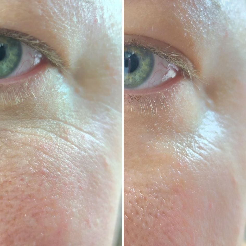 A before and after close-up shot of an eye, showing a reduction in fine lines and wrinkles.
