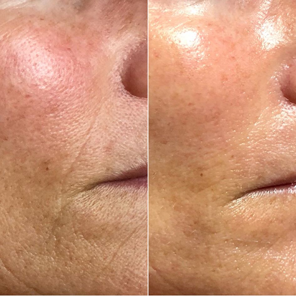 A before-and-after close-up of facial skin, showing a reduction in wrinkles and improved texture on the right side.