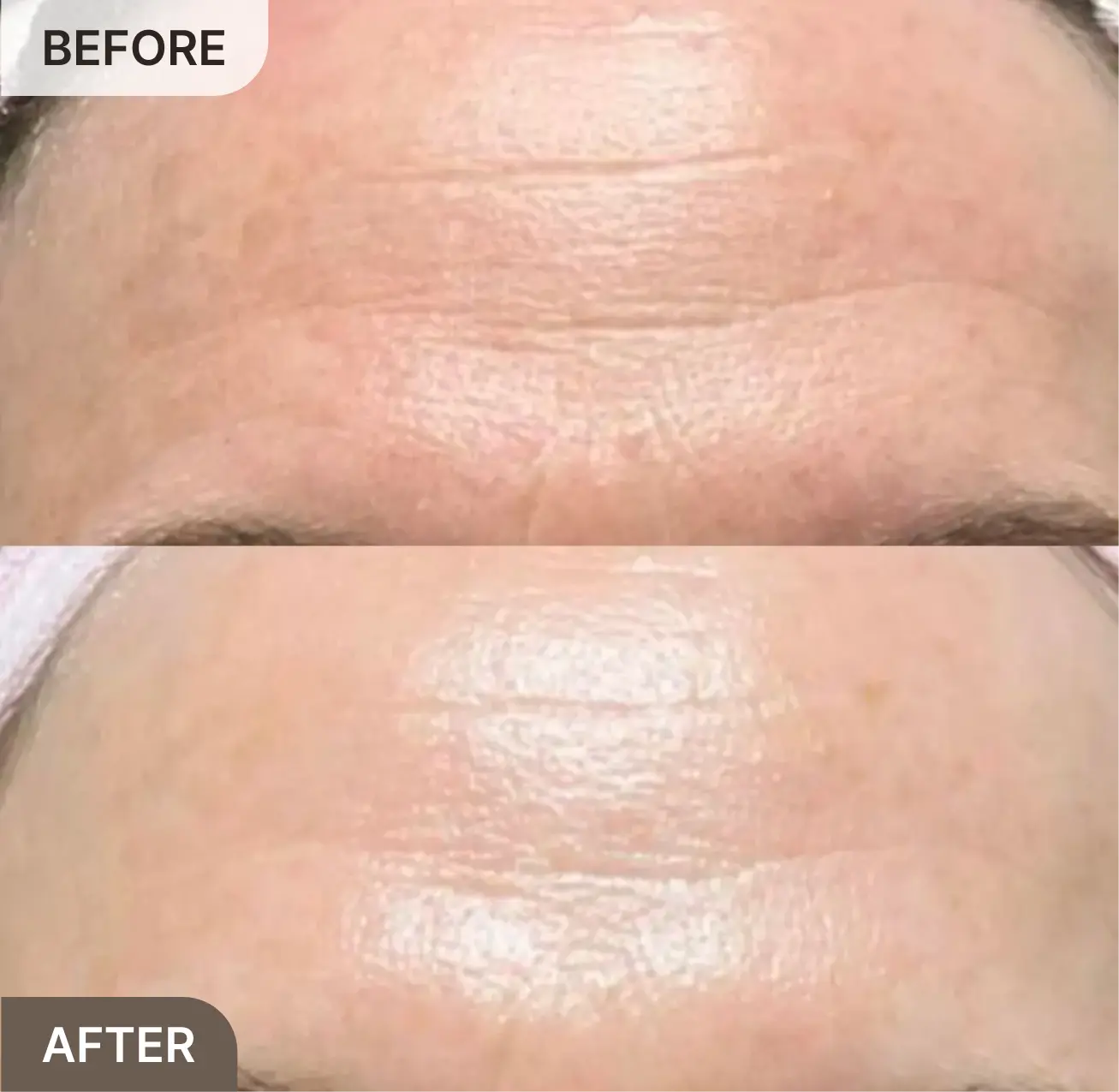 A before and after image showing a close-up of forehead wrinkles which appear reduced and smoother.
