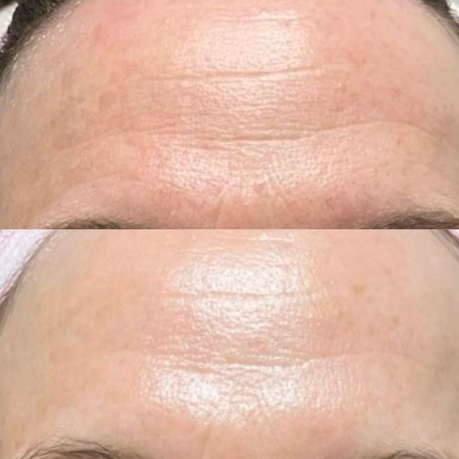 A before-and-after comparison showing a reduction in wrinkles and improved skin texture on a person's forehead.