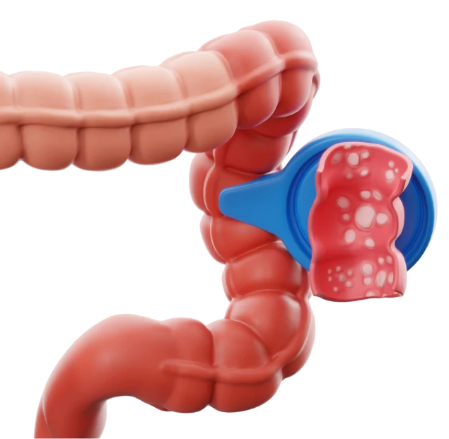 A 3D medical illustration showing a scope examining a diseased section of the large intestine.