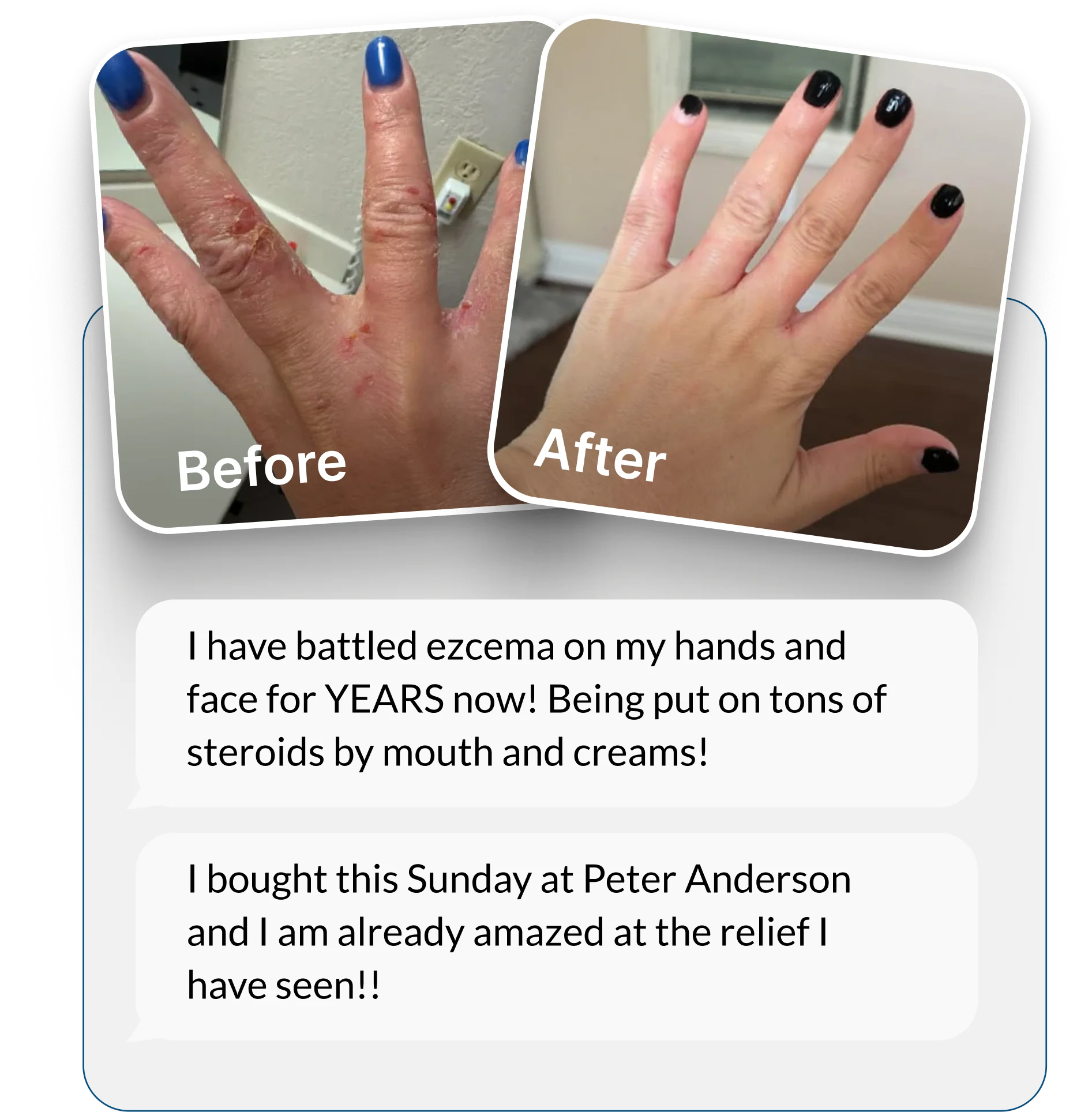 Before and after photos showing a hand with severe eczema healed to be smooth and clear.
