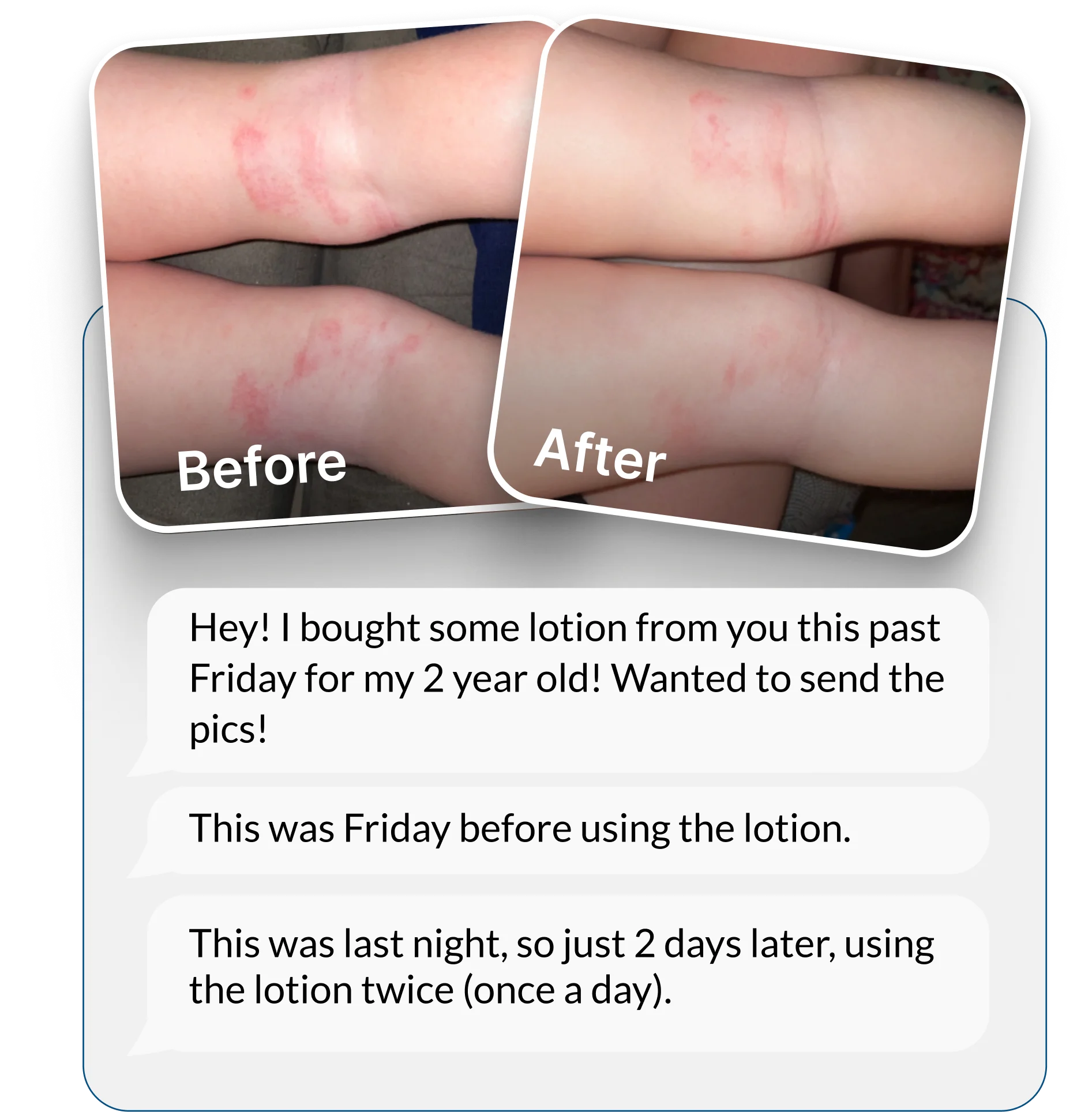 A before and after photo showing a reduction of a rash on a child's legs.