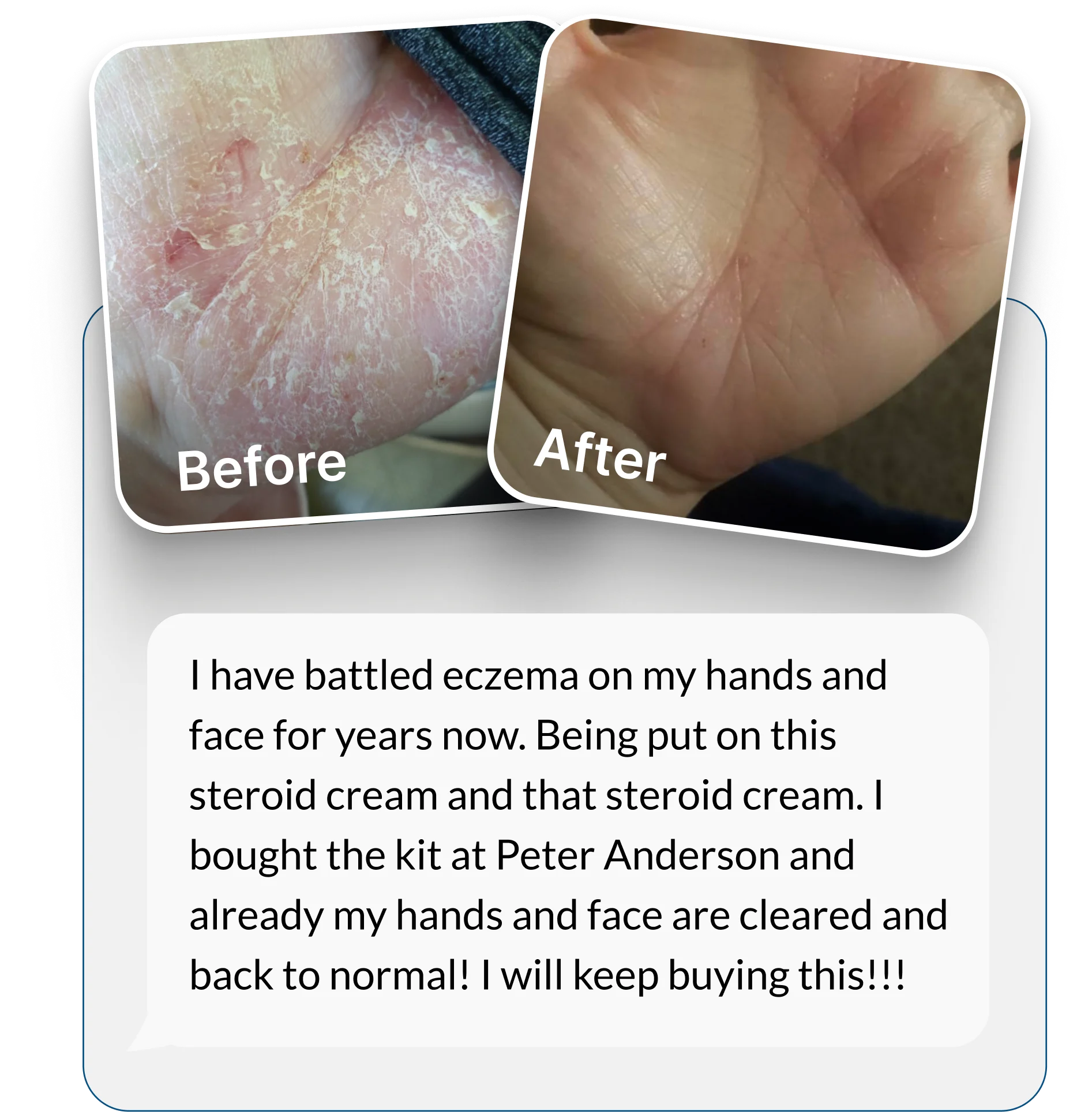 A before and after comparison of a hand with severe eczema, showing significant healing and smoother skin.