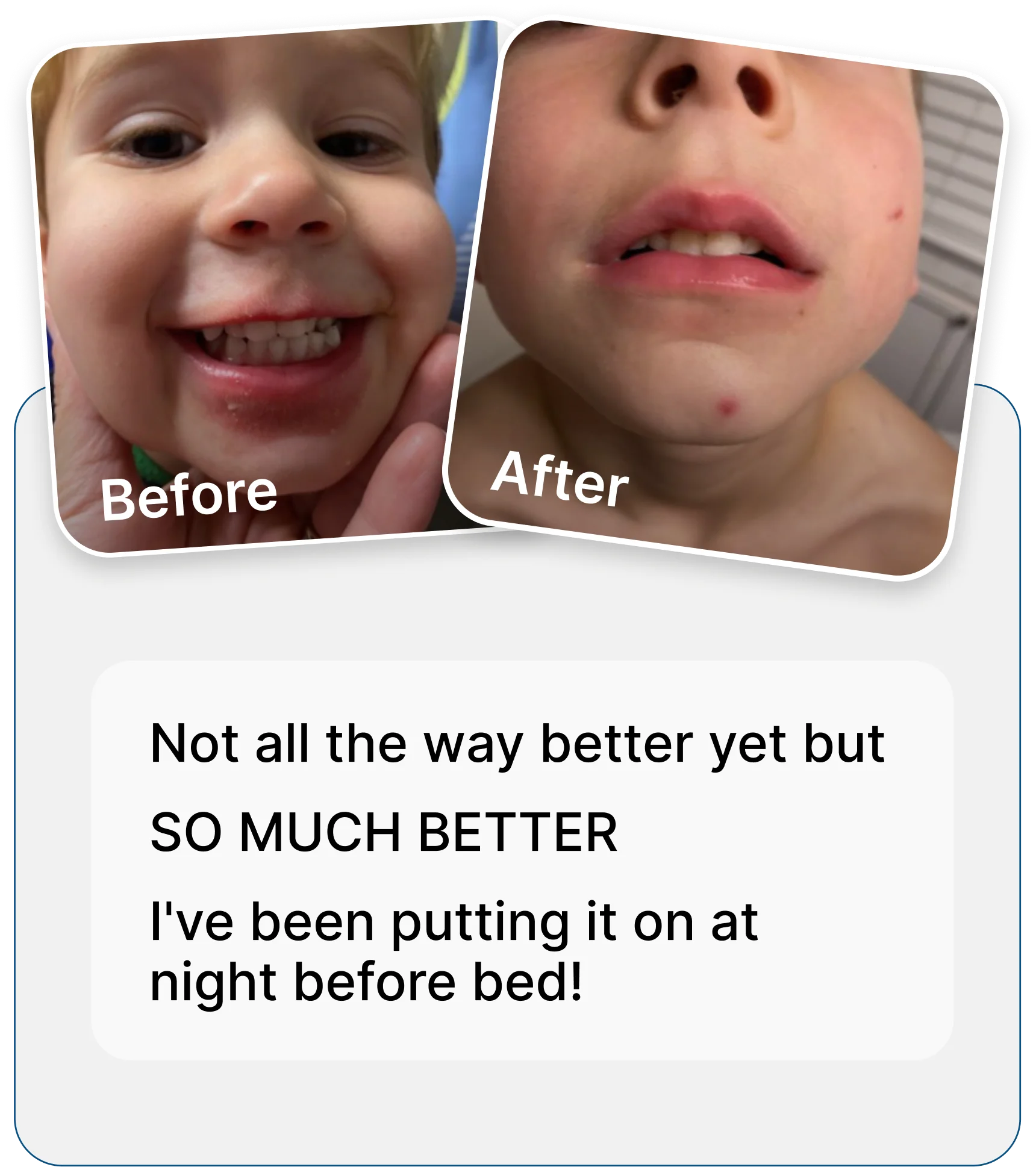 Before and after photos of a child's irritated skin around the mouth, showing significant improvement in the second photo.