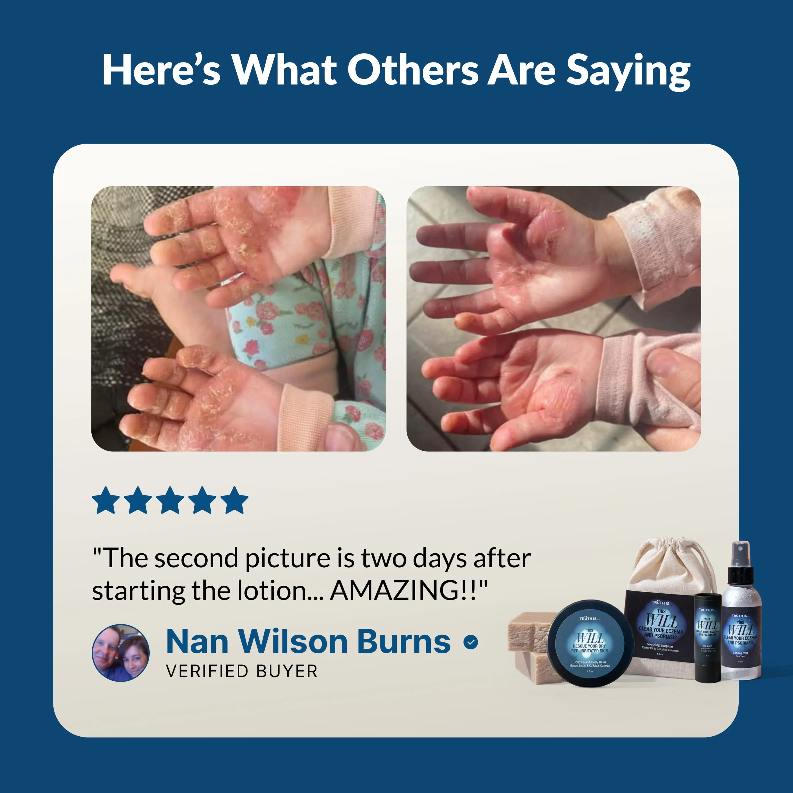 A customer testimonial with before and after photos of a skin condition on a child's hands and product images.