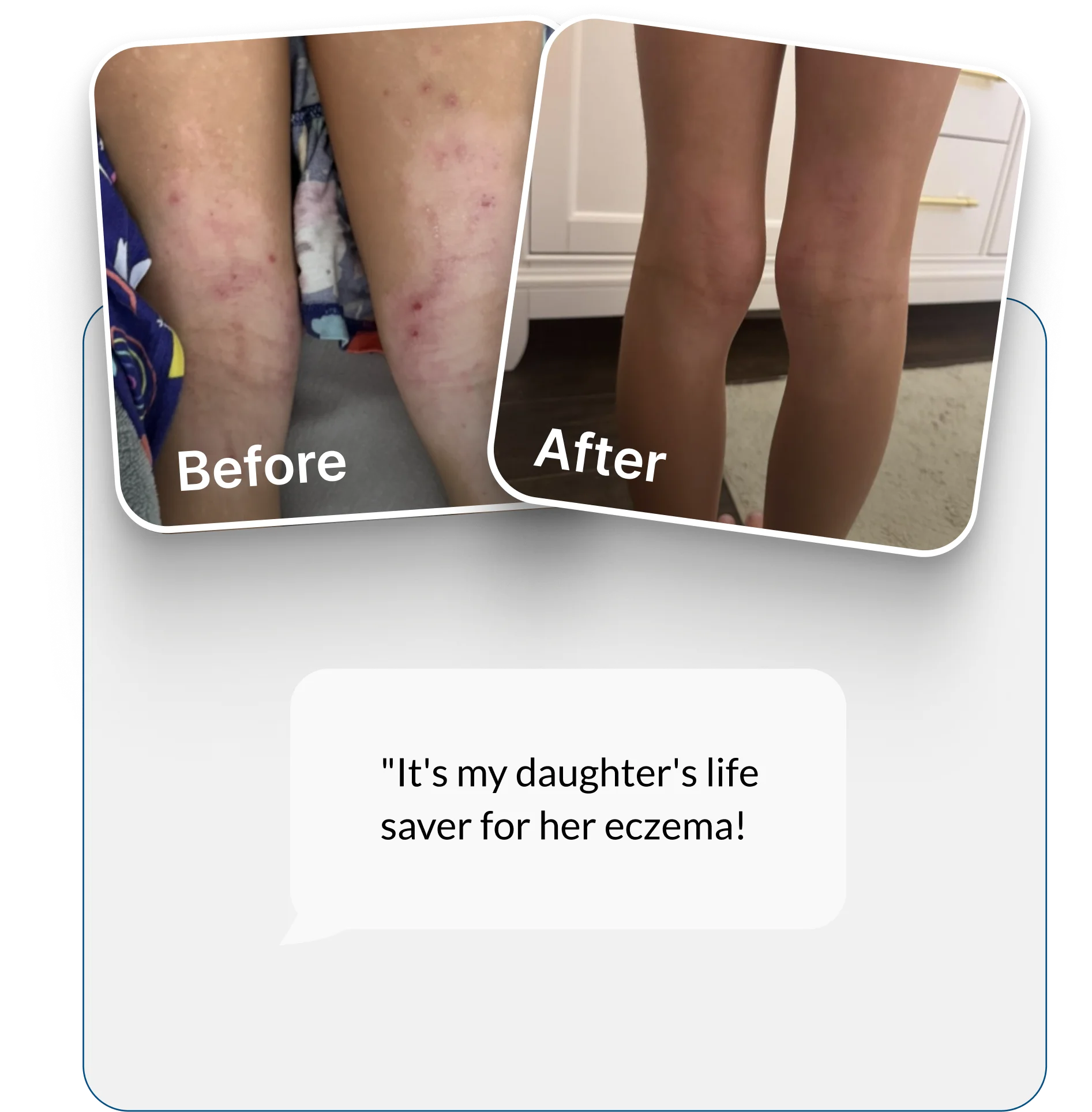 A before-and-after photo showing significant improvement of a skin condition on a person's legs.