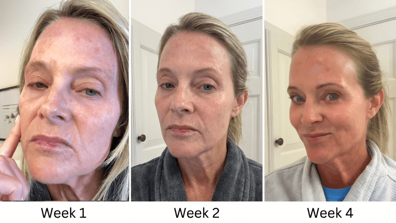 Progression of skin condition improvement over four weeks in three images.