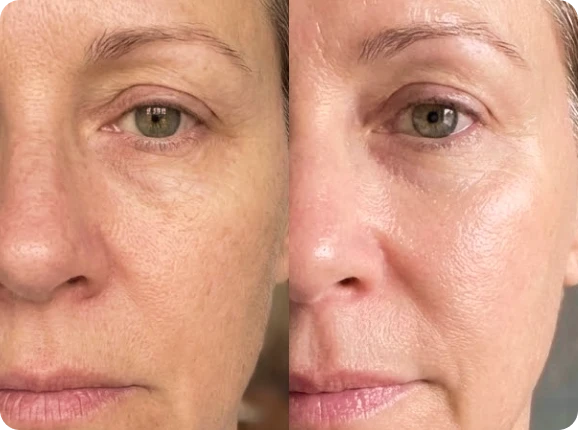 Close-up comparison of a woman's face showing skin texture before and after treatment.