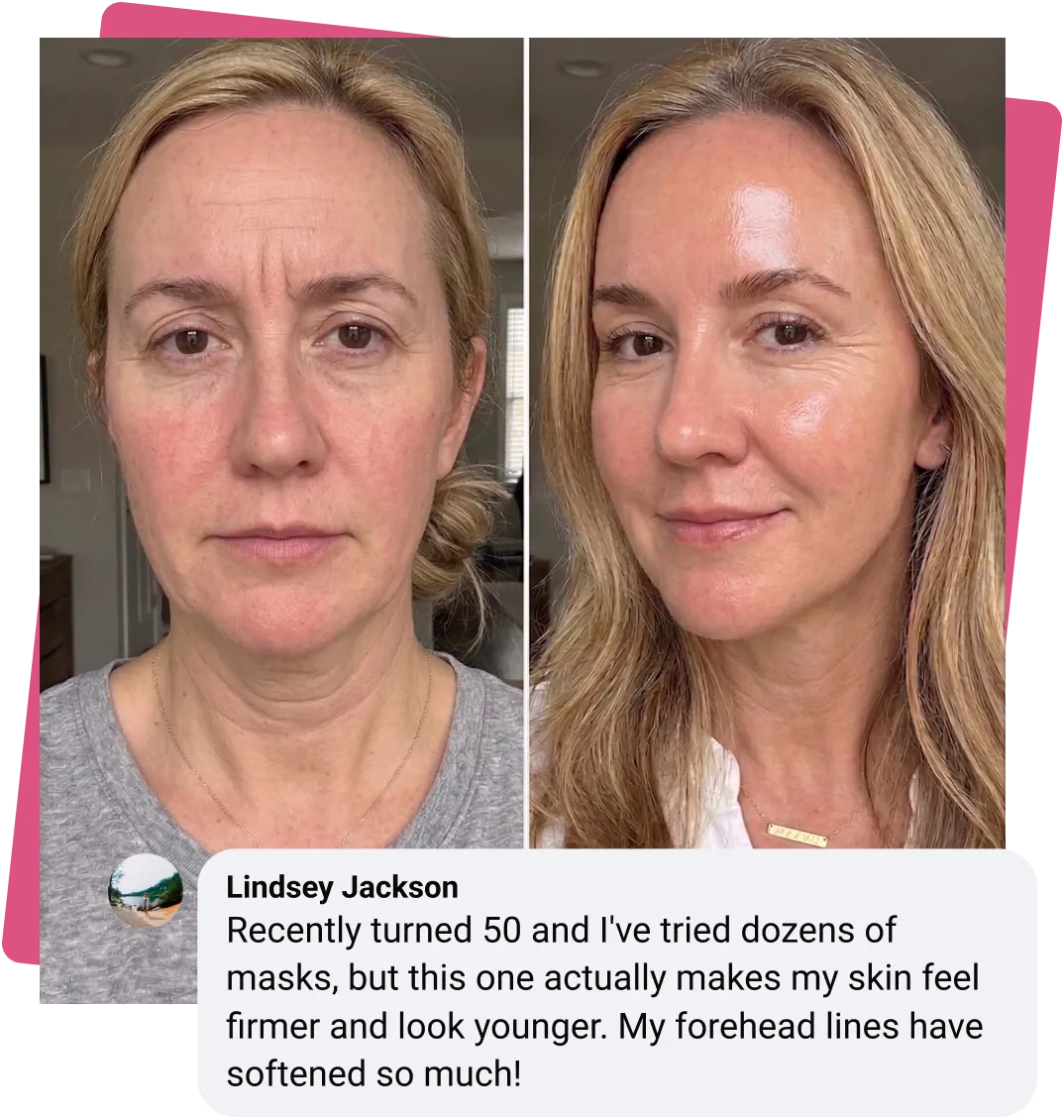 Before and after photos of a woman's face, showing a reduction in the appearance of wrinkles and lines.