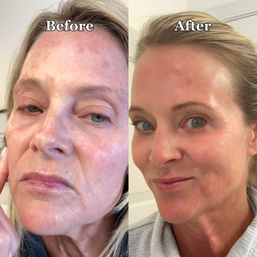 Side-by-side comparison of a woman's face labeled 'Before' and 'After'.
