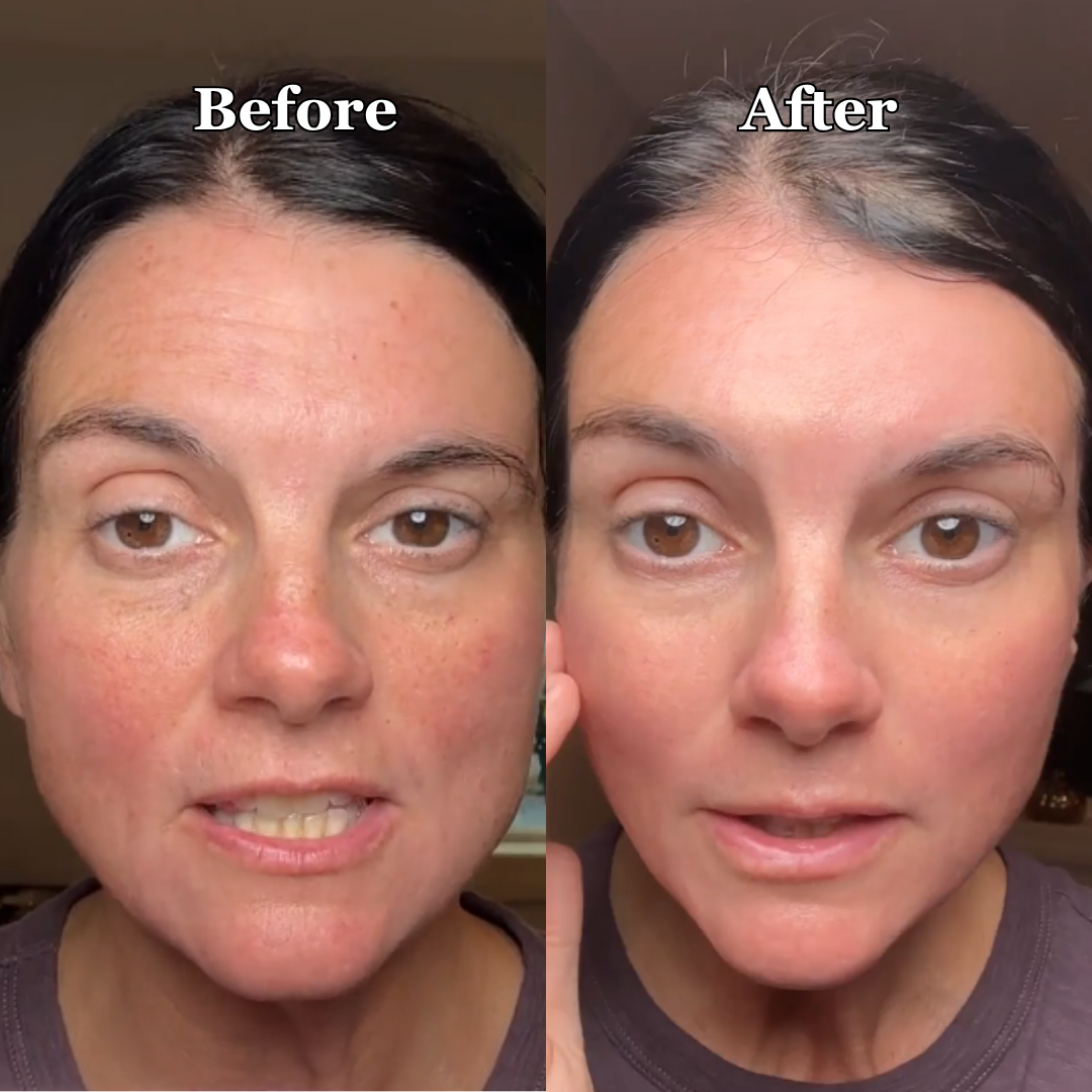 Side-by-side comparison of a woman's face before and after treatment.