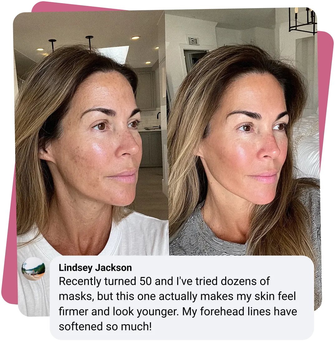 Two side-by-side images of a woman's face showing skin improvement.