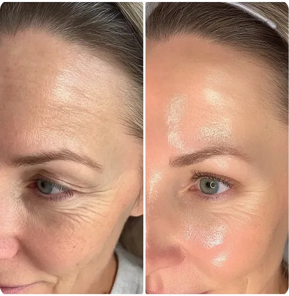 Side-by-side comparison of a woman's forehead and eye area, before and after treatment.