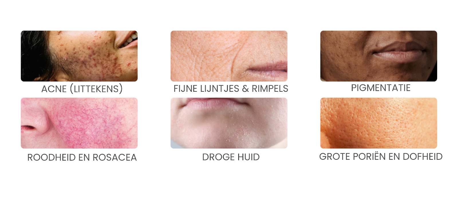 Collage of six close-up images showing various skin conditions with Dutch labels.