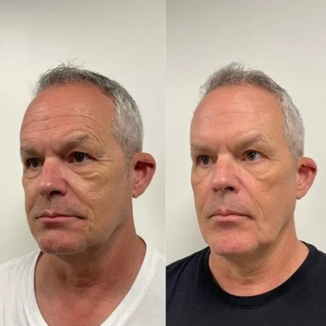 Antes y después - resultado 3