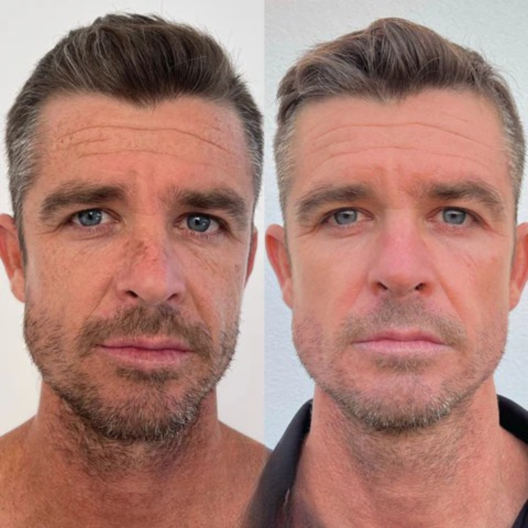 Antes y después - resultado 2