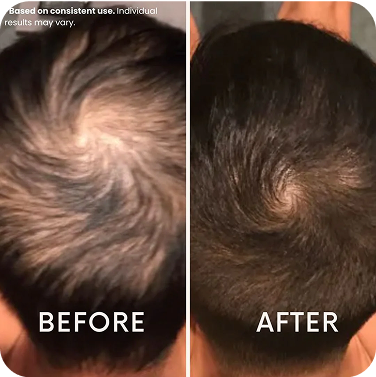 Before and after hair growth comparison on the top of a person's head.