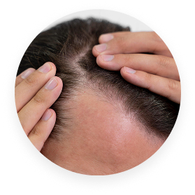 Hands pulling back hair to show the scalp.