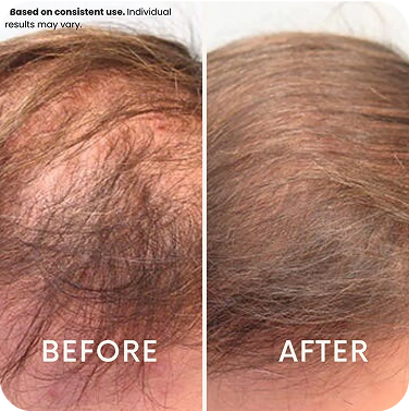 Side-by-side comparison of thinning and fuller hair labeled 'Before' and 'After'.